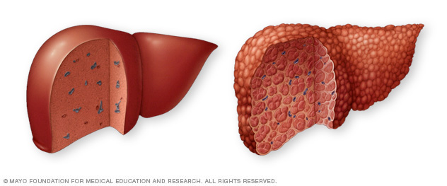 Typical and cirrhotic livers