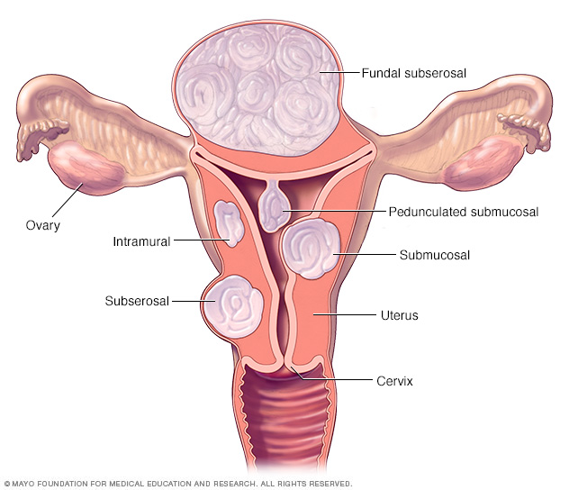 Fibroid locations