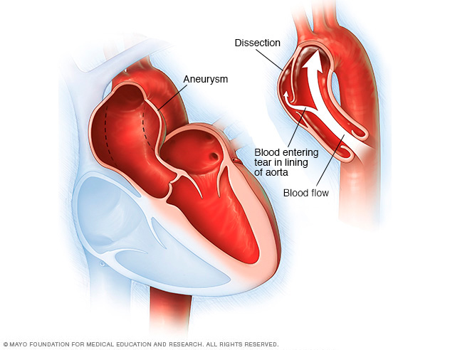 An aortic dissection and aortic aneurysm