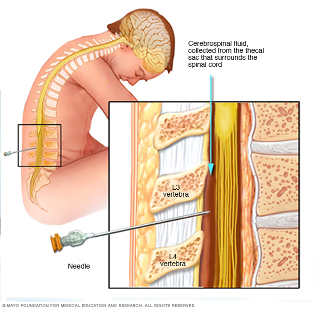 Lumbar puncture, also called a spinal tap