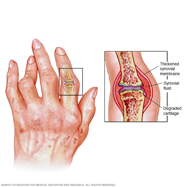 Rheumatoid arthritis