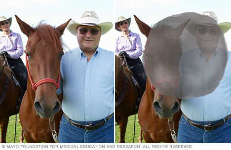 Photographs depicting typical vision and vision with macular degeneration