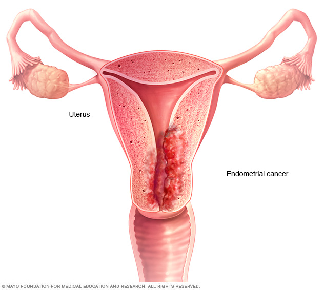 Endometrial cancer