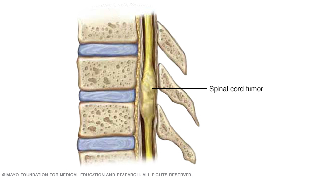 Tumor in the interior of the spinal cord