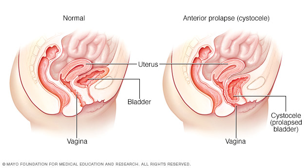 Typical bladder compared with prolapsed bladder (cystocele)