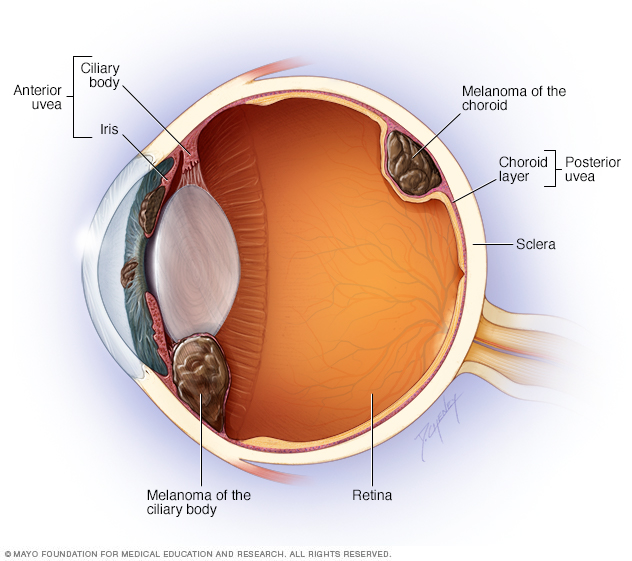 Where eye melanoma occurs