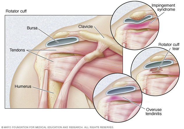 Types of rotator cuff injuries