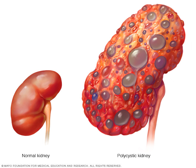 A typical kidney compared with a polycystic kidney