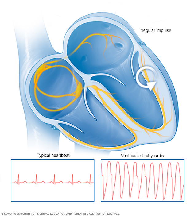 Ventricular tachycardia heartbeat