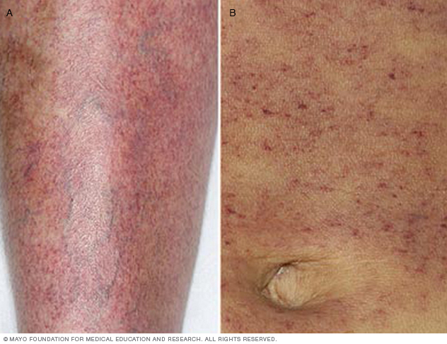 Photograph of petechiae on leg and abdomen