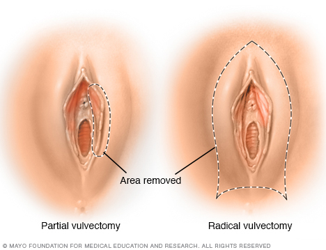 Partial vulvectomy and radical vulvectomy
