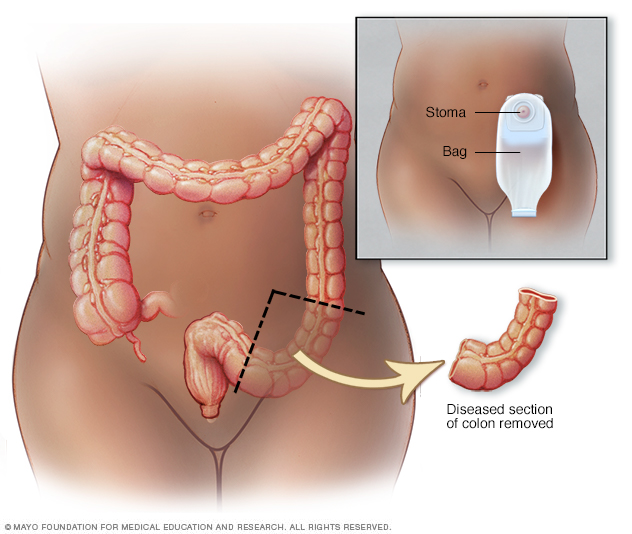 Partial colectomy surgery for colon cancer