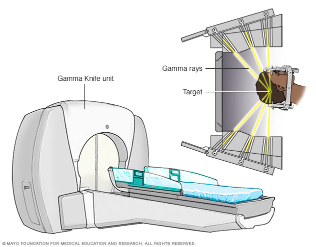 Gamma Knife stereotactic radiosurgery