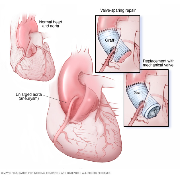 Ascending aortic root aneurysm repair and replacement