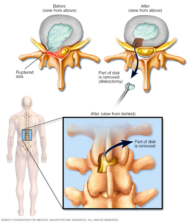 Removal of herniated portion of spinal disk