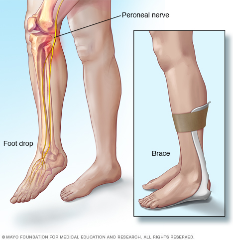 Foot drop and brace