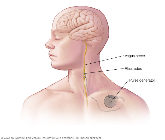 An implanted vagus nerve stimulation